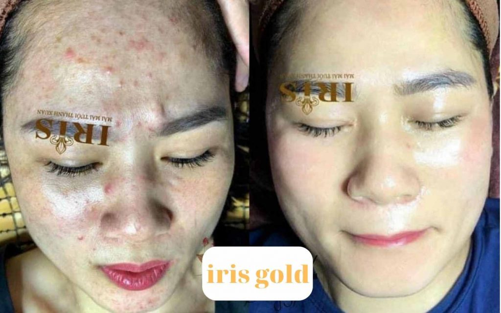 Điều trị ca mụn cho khách hàng bằng Mỹ Phẩm Iris Gold